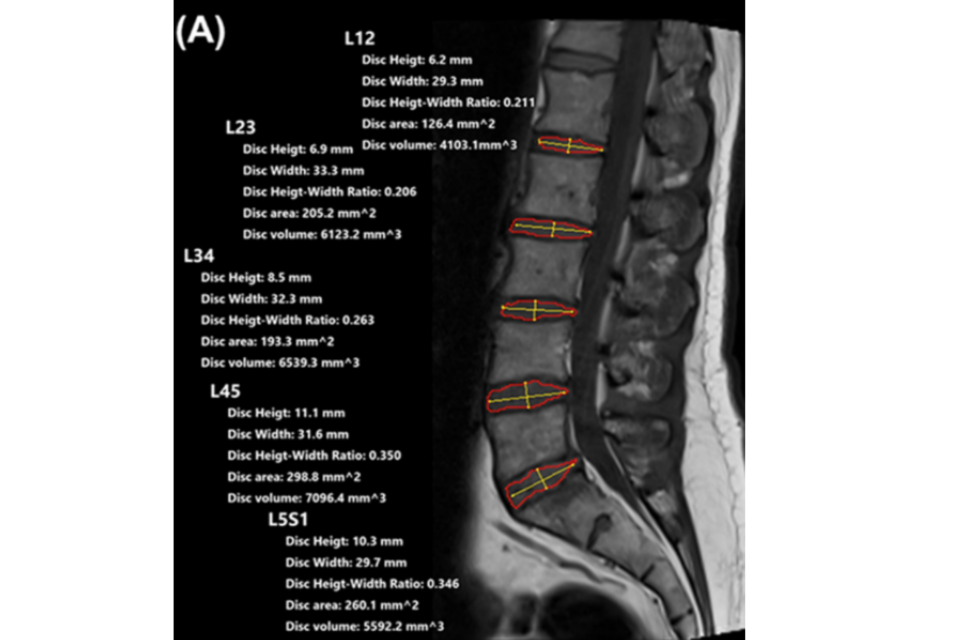 사진은 AI 기반 척추 영상분석 시스템 ‘RadiSpine’. (사진=청담해리슨병원)