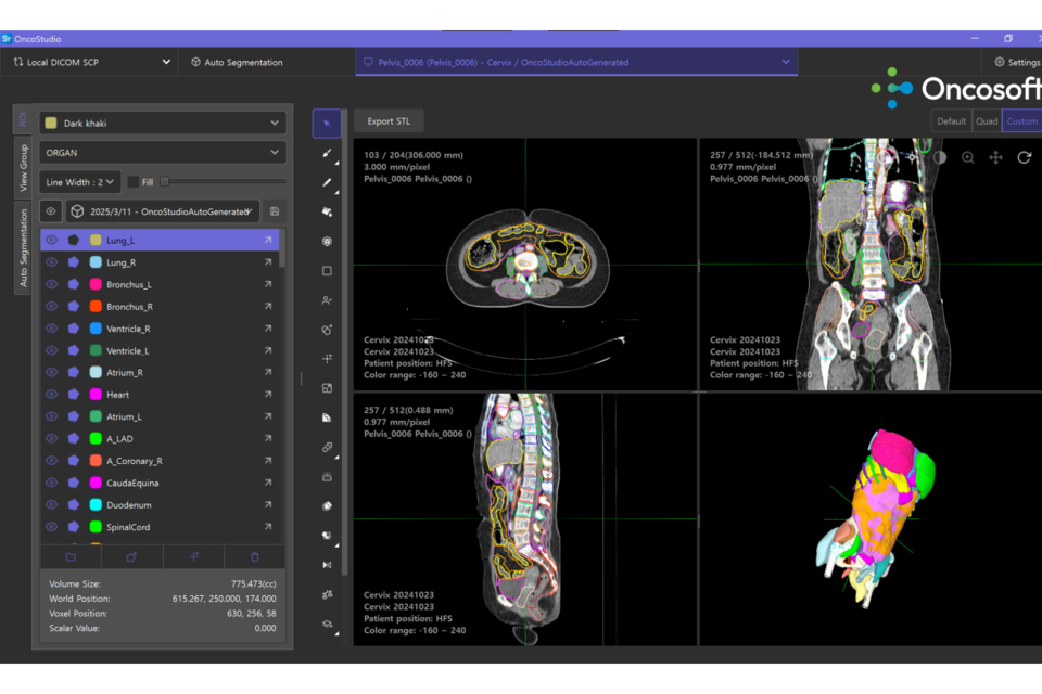 온코소프트의 AI 기반 자동 컨투어링 소프트웨어 ‘OncoStudio 2.0’. (사진=온코소프트)